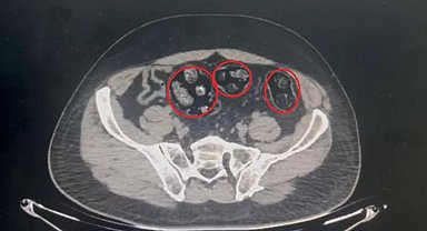 Yolcunun midesinden 62 parça uyuşturucu çıktı