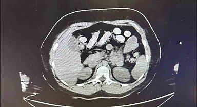 1.5 kilo metamfetamin iki kadın kuryenin bağırsak ve midesinden çıktı