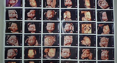 7 yıllık bebek hasreti "kişiye özel" tedaviyle son buldu