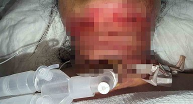 Gıdı estetiği sonrası nefes alamadı, boynundan acil solunum yolu açıldı