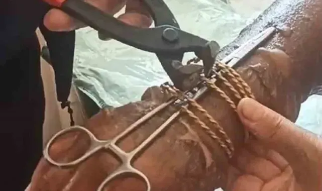 Kolu yanan kadının bilezikleri kesilerek çıkartıldı