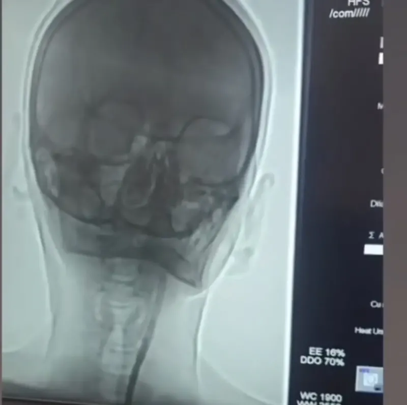 Iğdır'da Şah Damarı Tıkanıklığı Olan Hastaya Başarılı Stent Operasyonu