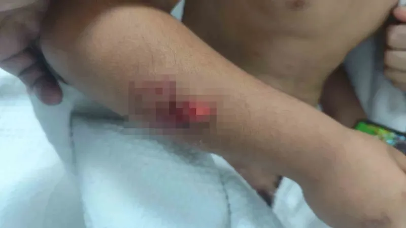 Viranşehir’de Okul Çıkışı Köpek Saldırısına Uğrayan Çocuğun Başına 15 Dikiş Atıldı